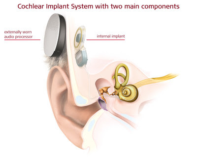 MED-EL: First Surgeries Ever in Europe with a Totally Implantable Cochlear Implant